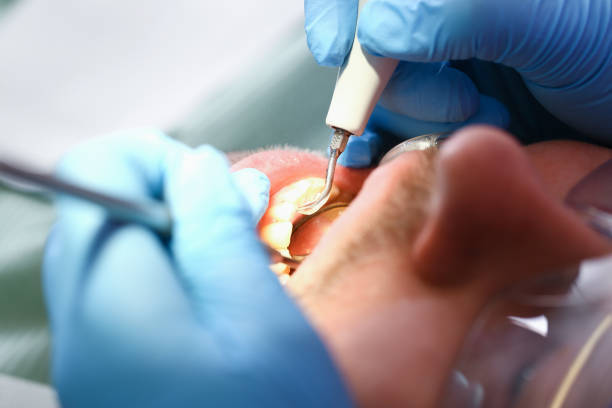 Best Emergency Treatment for Oral Infections in West Columbia, SC